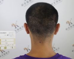 -大麦微针植发丨全国连锁