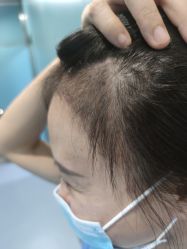 -大麦微针植发全国连锁