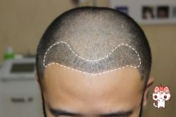 -大麦微针植发丨全国连锁