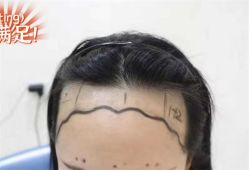 -大麦微针植发全国连锁
