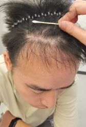 -大麦微针植发全国连锁