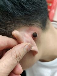 -北京美痣堂古方祛痣斑疣瘊