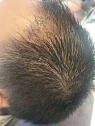 -大麦微针植发丨全国连锁