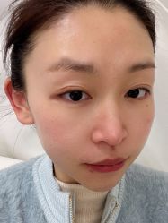 体验后-圣嘉新医疗美容医院