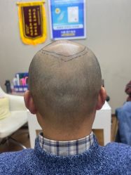 体验前-大麦微针植发全国连锁