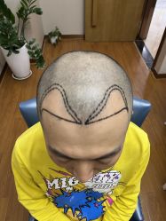 体验前-大麦微针植发全国连锁