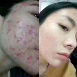 点击看大图 -痘博士广州·全国连锁祛痘机构