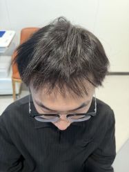 -大麦微针植发全国连锁
