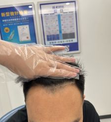 体验后-大麦微针植发全国连锁