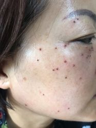 -北京美痣堂古方祛痣斑疣瘊