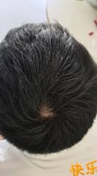 -大麦微针植发丨全国连锁