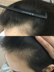 -菩叶脱发白发中心