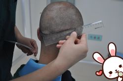 点击看大图 -大麦微针植发丨全国连锁