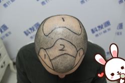 -大麦微针植发丨全国连锁