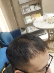 点击看大图 -碧莲盛·不剃发植发