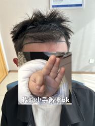体验前-大麦微针植发丨全国连锁