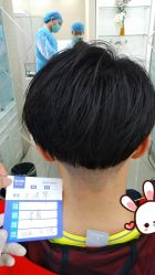 -大麦微针植发丨全国连锁