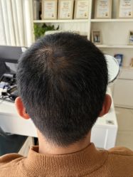 -大麦微针植发丨全国连锁