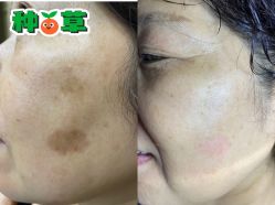 -爱莎扁平疣·汗管瘤·斑痣中心