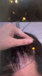 -碧莲盛·不剃发植发