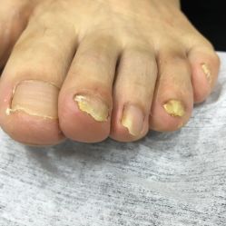 点击看大图 -德哥灰指甲脚气甲沟炎跖疣护理