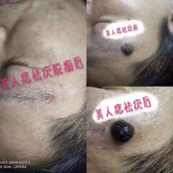 -美人痣全国连锁