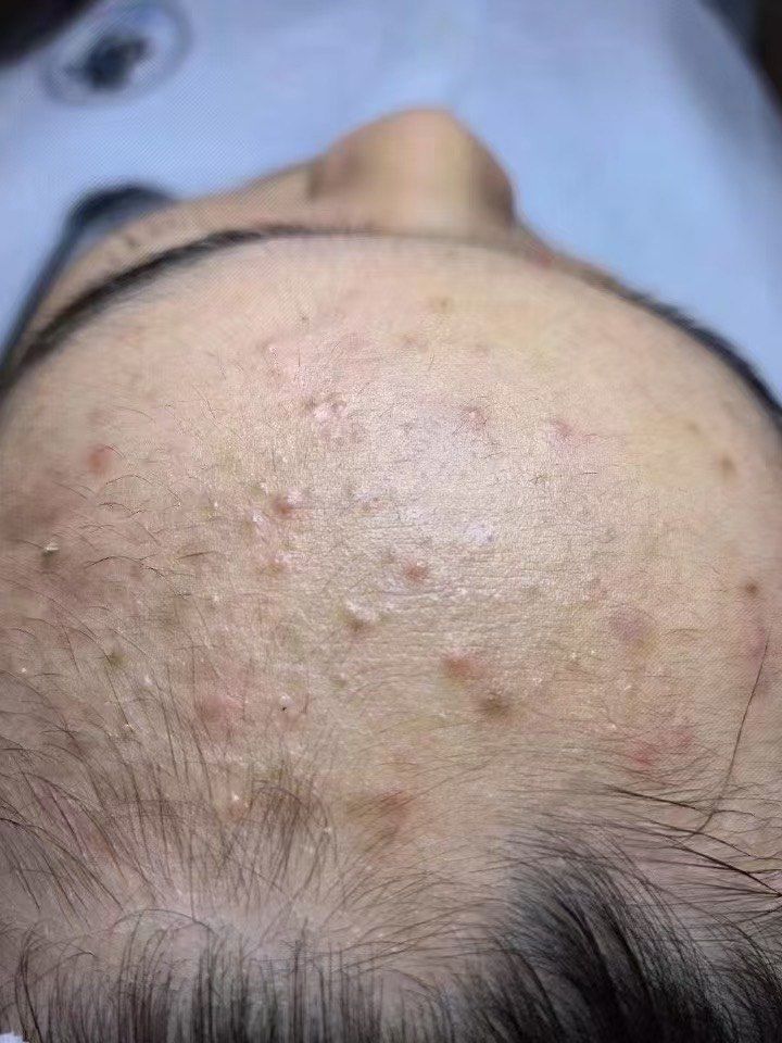 14岁的小女孩毛孔全堵了,
怎能不爆