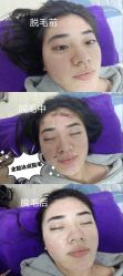 -小梨·OndaPro·专业脱毛连锁机构