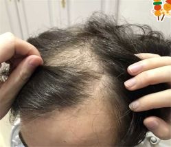 -大麦微针植发全国连锁
