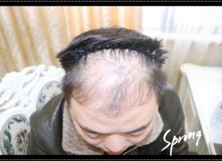 点击看大图 体验后-大麦微针植发全国连锁