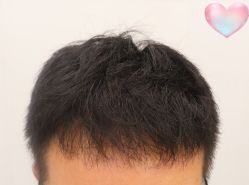 -大麦微针植发全国连锁