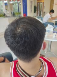-大麦微针植发全国连锁