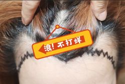 -大麦微针植发全国连锁