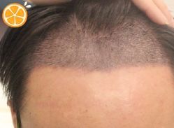 -大麦微针植发丨全国连锁