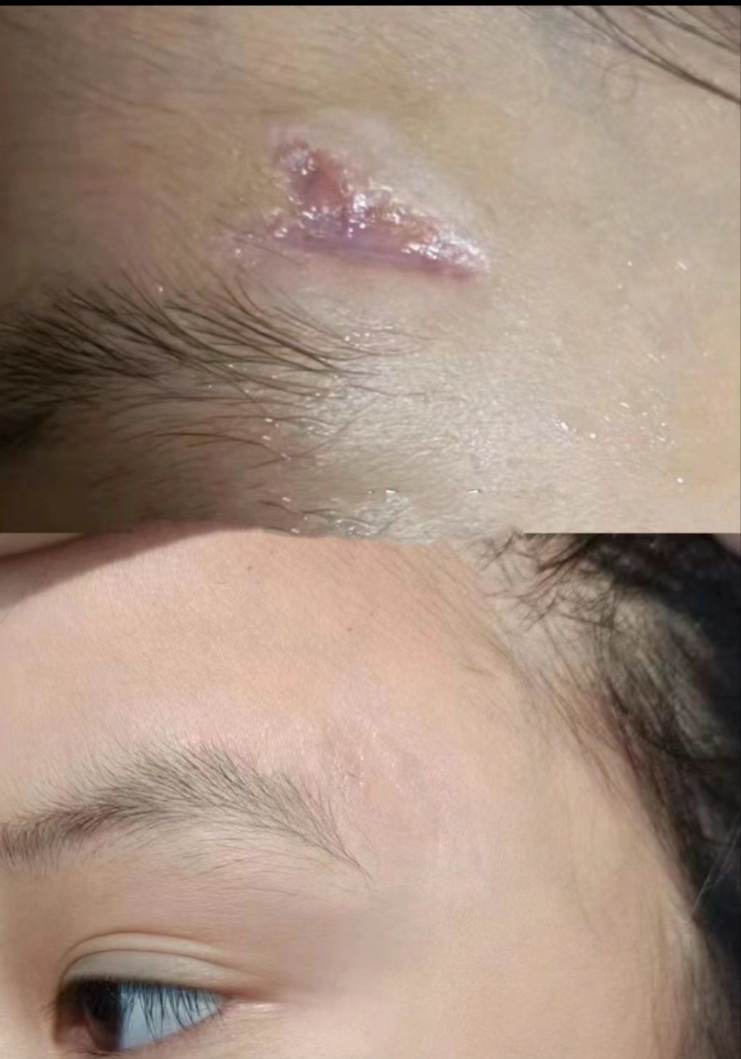 体验激光祛疤痕60天后分享