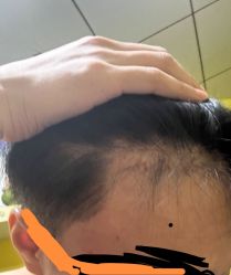 -碧莲盛·不剃发植发