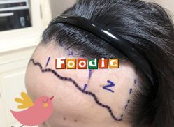 -大麦微针植发全国连锁