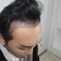 -大麦微针植发丨全国连锁