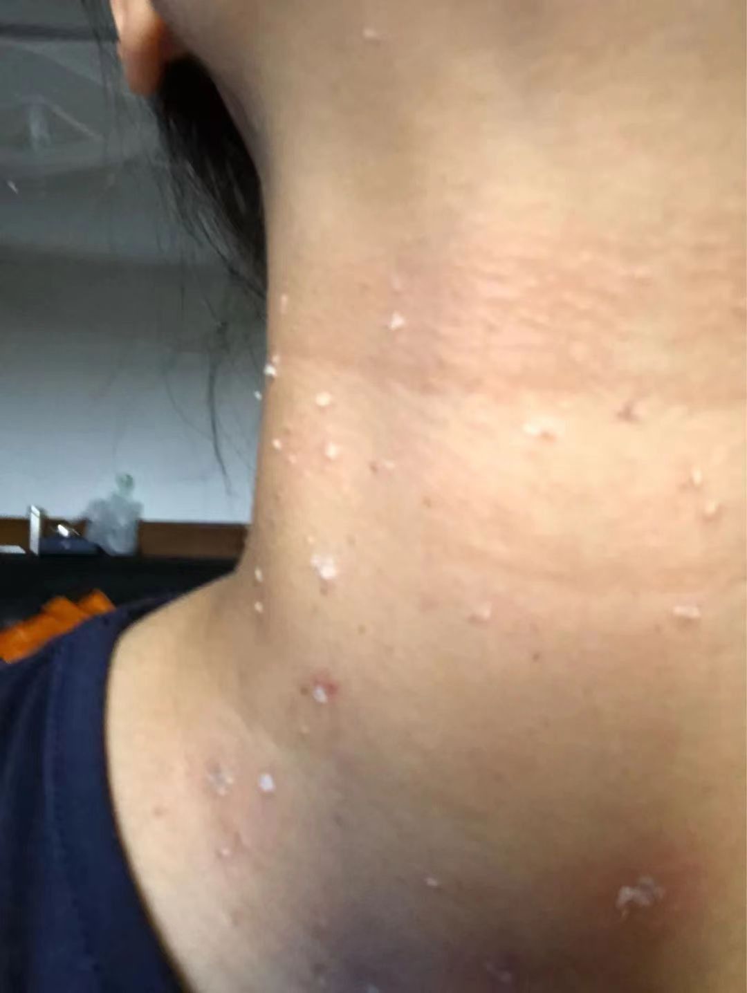 第三,疣可以降低人的免疫功能,所以有疣就要提前治疗