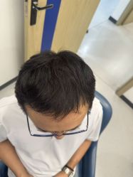 -大麦微针植发全国连锁