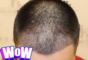 -大麦微针植发丨全国连锁