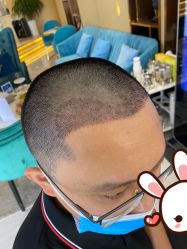 -大麦微针植发丨全国连锁