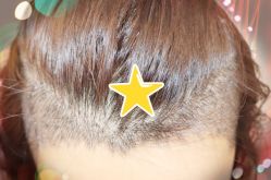 -大麦微针植发全国连锁