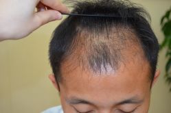 -大麦微针植发丨全国连锁