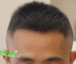 -大麦微针植发丨全国连锁