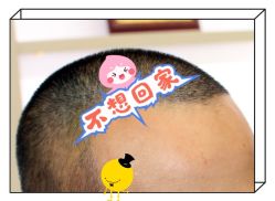 -大麦微针植发全国连锁