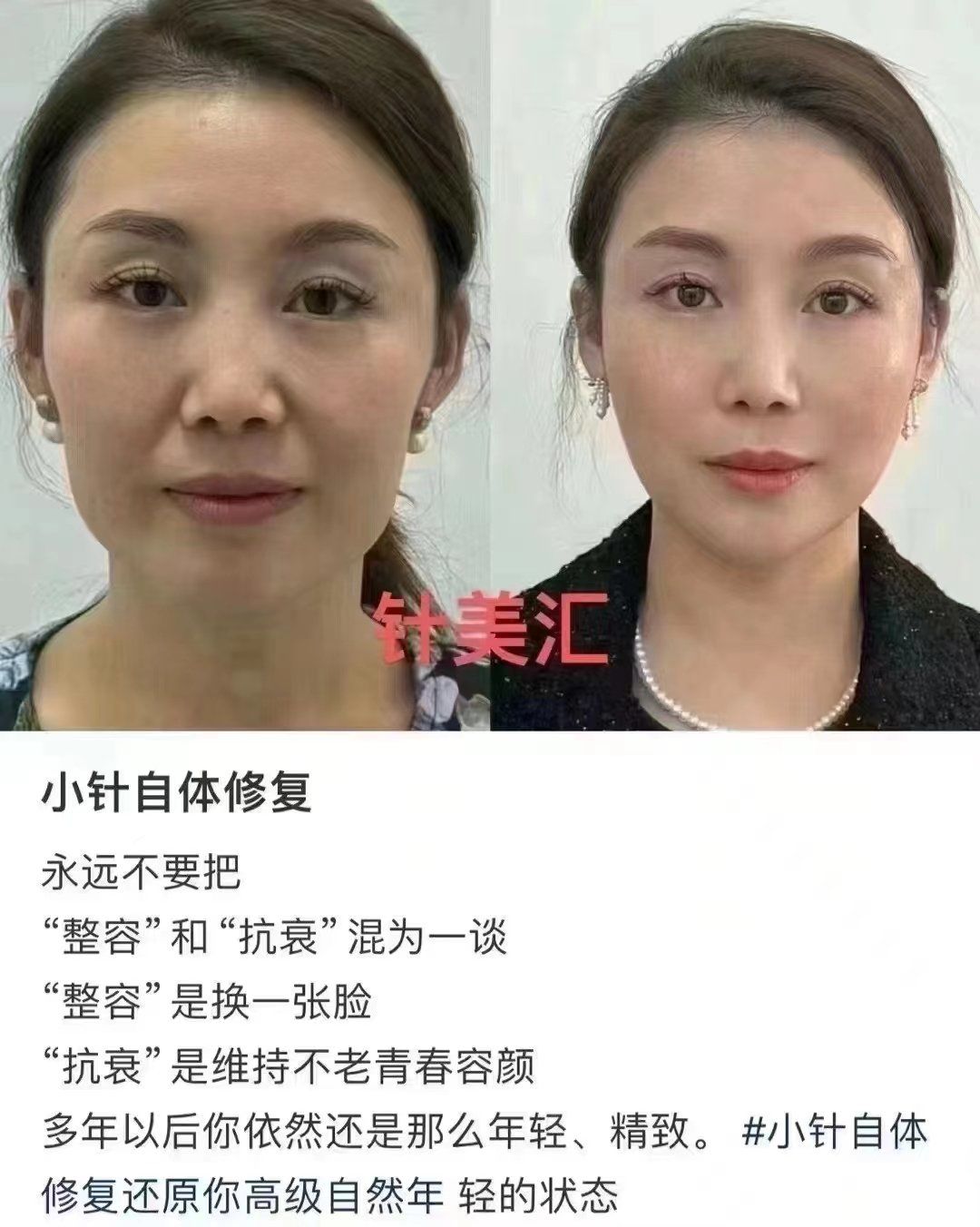 针美汇小针自体修复
永远不要把
