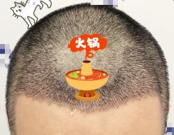 -大麦微针植发全国连锁