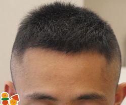 -大麦微针植发丨全国连锁