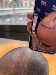 -碧莲盛·不剃发植发